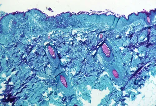 The next COVID? Everything you need to know about monkeypox